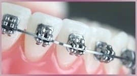 apparecchio ortodontico dentista roma